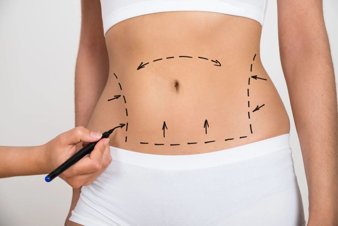Oznaczenie na brzuchu przed liposukcją, korekta sylwetki